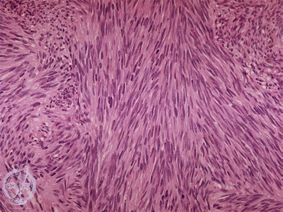 Gastrointestinal stromal tumor (GIST)~NiHEgj
