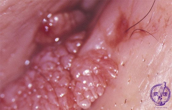 15.女性生殖器 (1)外陰部尖圭コンジローマ病理コア画像
