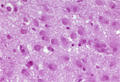 PזEiזEPj~NiHEgj Gemistocytic astrocytoma(^זEPj 