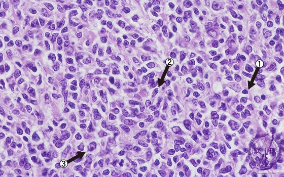 2.Lymph node (5) Follicular lymphoma|Pathology Core Pictures
