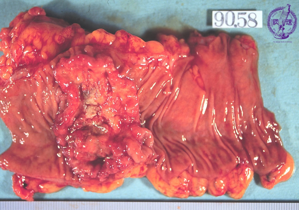 9 Small Intestine Large Intestine 9 Carcinoma Of The Colon