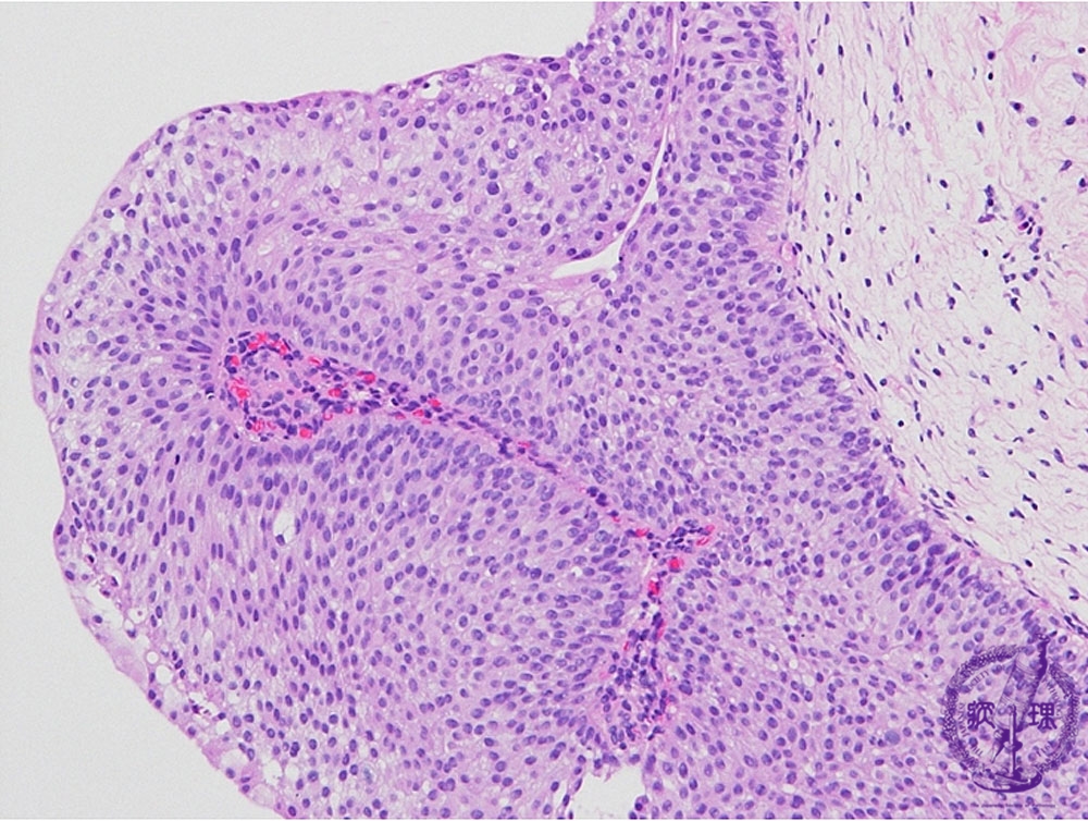 12-kidney-and-urinary-system-20-urothelial-carcinoma-transitional