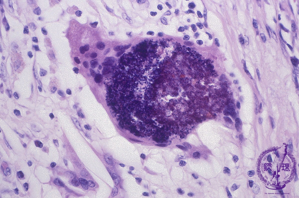 granulomas elevate psa Sperm