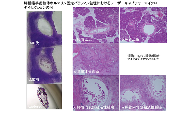 膵腫瘍手術検体ホルマリン固定パラフィン包埋におけるレーザーキャプチャーマイクロダイセクションの例