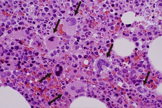 特発性血小板減少性紫斑病ミクロ像（HE強拡大）