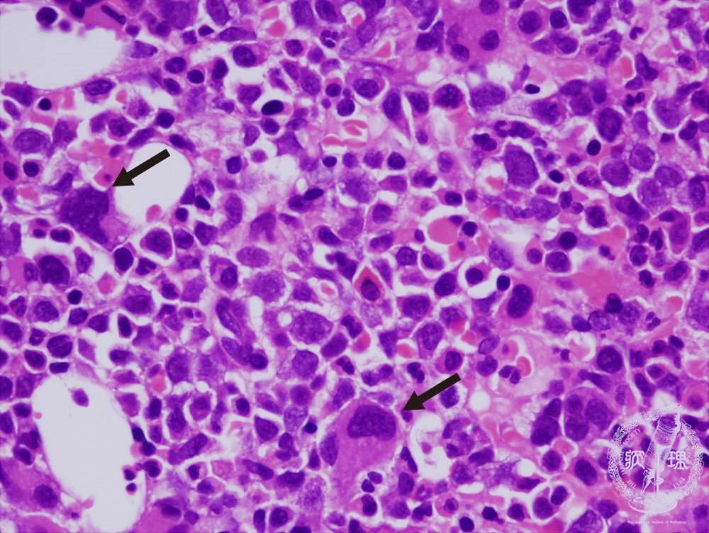 MDSを抱えて暮らしている人は何人いますか?