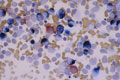急性骨髄性白血病（M2）ミクロ像（骨髄塗抹：エステラーゼ2重染色）