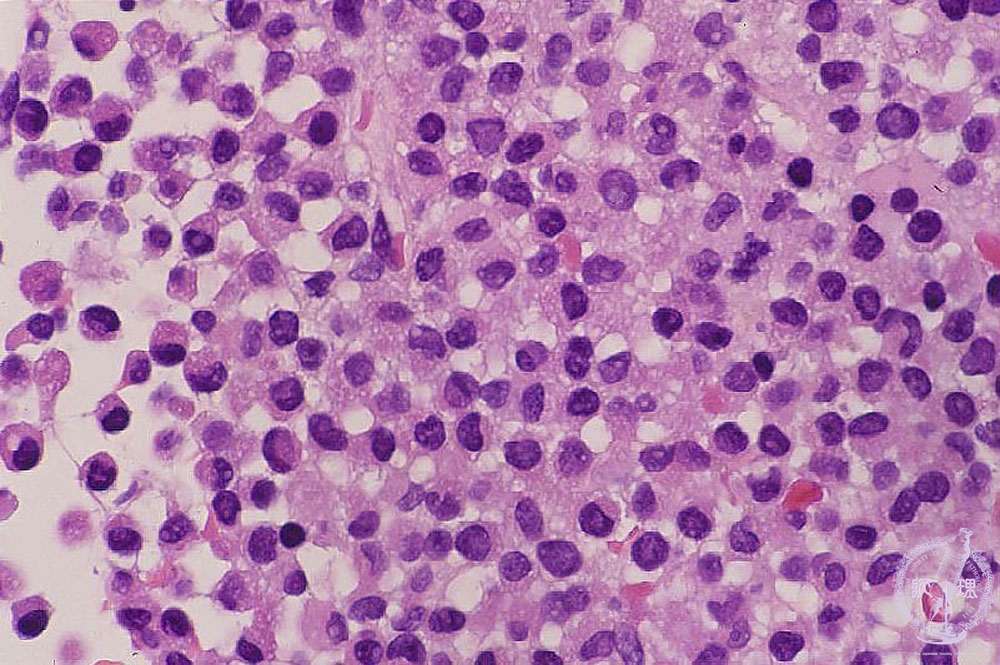 1.骨髄・造血器 (5)急性骨髄性白血病（M3）|病理コア画像