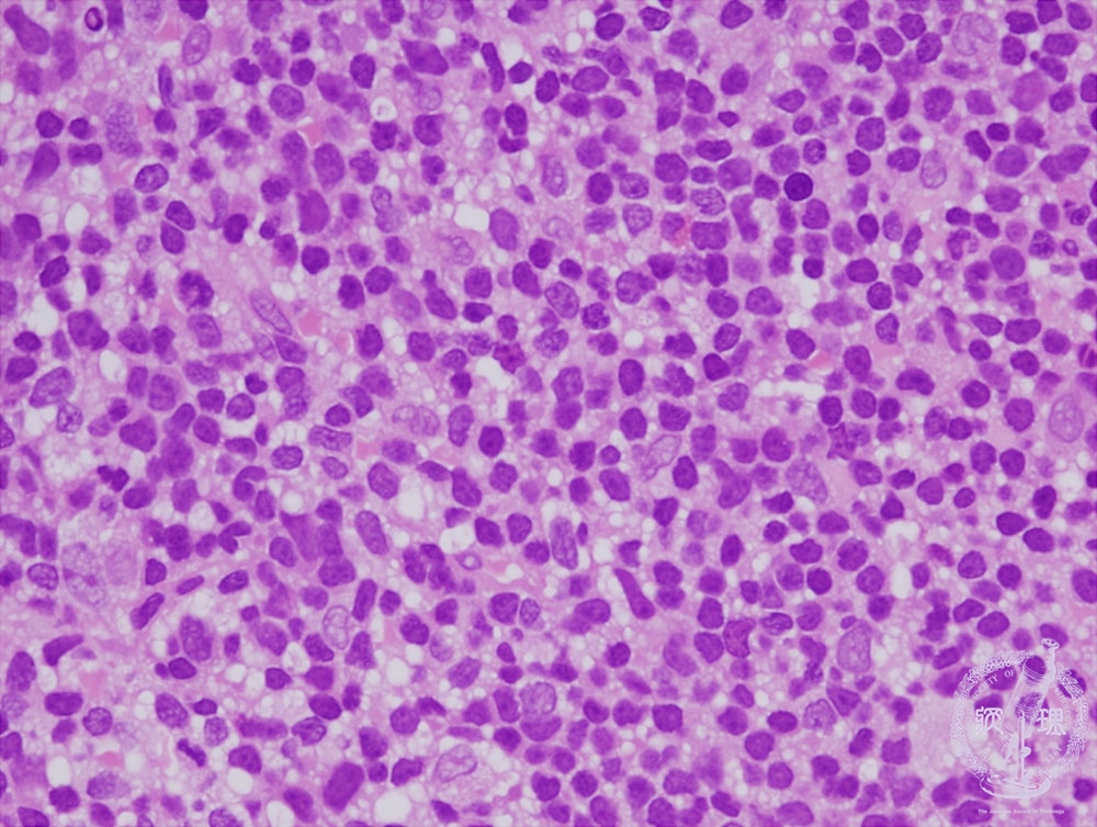 1 骨髄 造血器 7 急性リンパ性白血病 病理コア画像