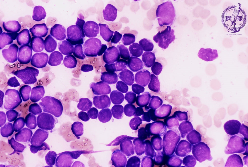 1 骨髄 造血器 7 急性リンパ性白血病 病理コア画像