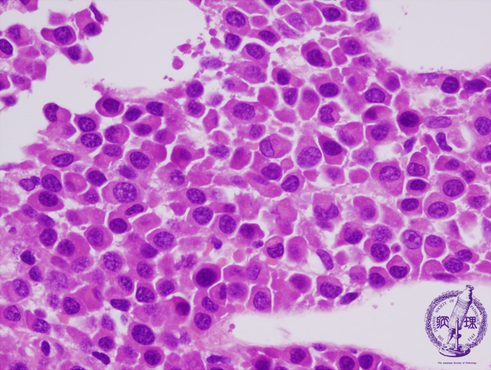 1.骨髄・造血器 (8)多発性骨髄腫|病理コア画像