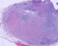組織球性壊死性リンパ節炎ミクロ像（HE弱拡大）