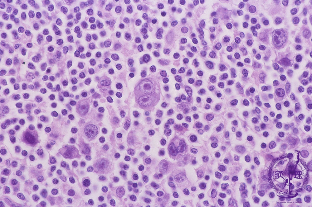 原因と危険因子