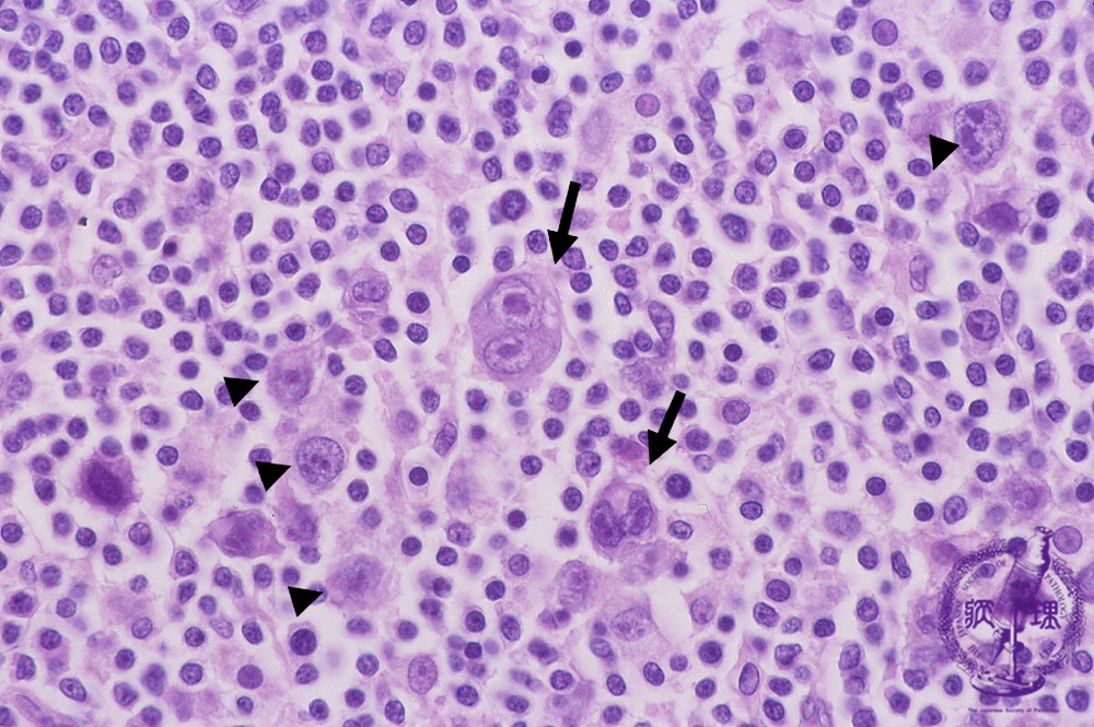ホジキンリンパ腫の原因は何ですか?