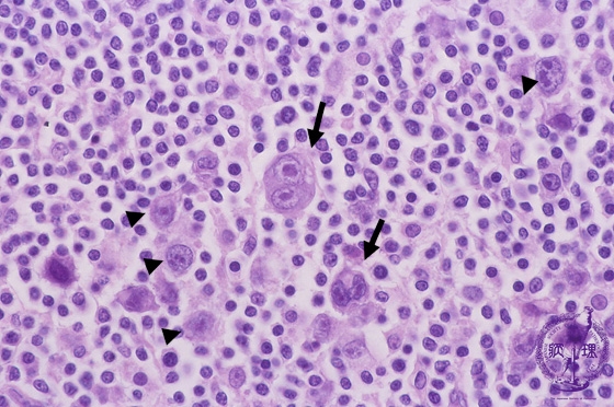 ホジキンリンパ腫（結節硬化型、混合細胞型）ミクロ像（HE強拡大）