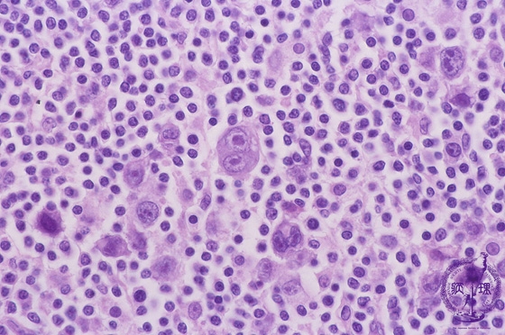 ホジキンリンパ腫（結節硬化型、混合細胞型）ミクロ像（HE強拡大）