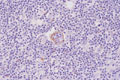 ホジキンリンパ腫（結節硬化型、混合細胞型）ミクロ像（CD30免疫染色）