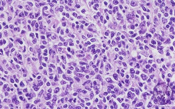 濾胞性リンパ腫ミクロ像（HE強拡大）