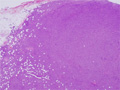 びまん性大細胞型Ｂ細胞性リンパ腫ミクロ像（HE弱拡大）