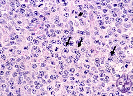 びまん性大細胞型Ｂ細胞性リンパ腫ミクロ像（HE強拡大）
