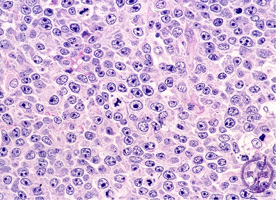  B細胞性慢性リンパ性白血病の症状