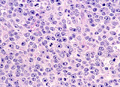 びまん性大細胞型Ｂ細胞性リンパ腫ミクロ像（HE強拡大）