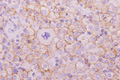 びまん性大細胞型Ｂ細胞性リンパ腫ミクロ像（CD20免疫染色）