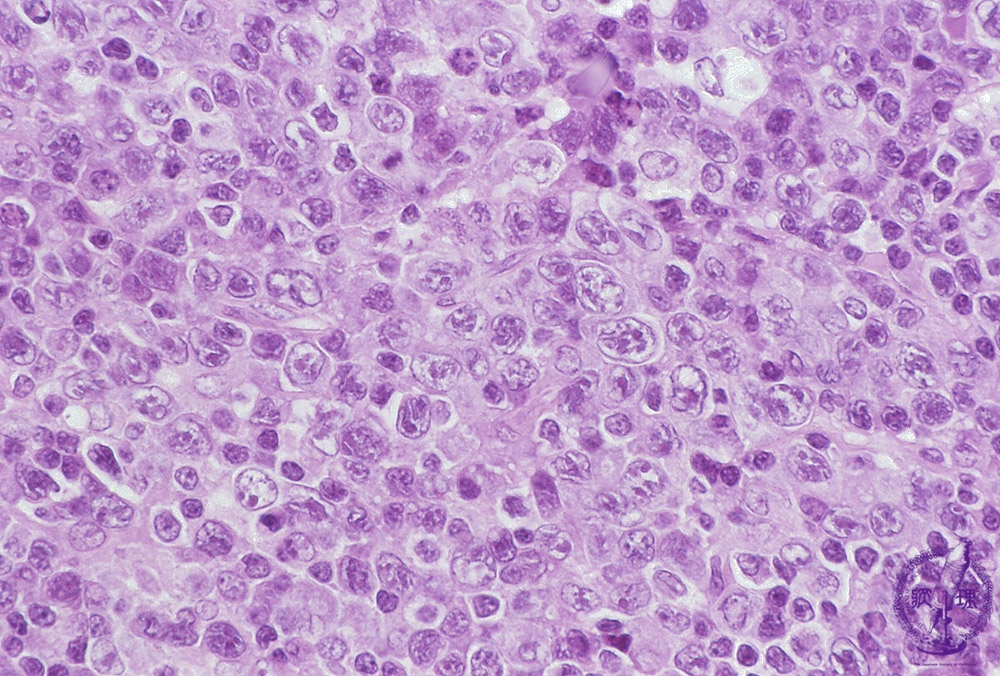 T細胞リンパ腫の病期分類