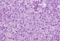 成人Ｔ細胞性白血病・リンパ腫ミクロ像（HE強拡大）
