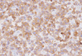 成人Ｔ細胞性白血病・リンパ腫ミクロ像（CD3免疫染色）