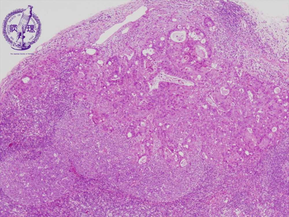 2 リンパ節 9 リンパ節への癌転移 病理コア画像