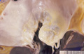 弁膜症(リウマチ性)マクロ像マクロ像(リウマチ性僧帽弁狭窄症)