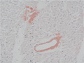 心アミロイドーシスミクロ像(Congo-red染色弱拡大）
