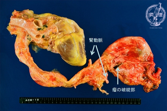 動脈硬化症（大動脈粥状硬化症）マクロ像(腹部大動脈瘤)