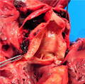 大動脈解離（解離性大動脈瘤）マクロ像