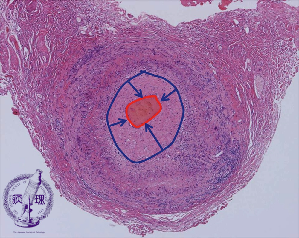 巨細胞性動脈炎の治療法は何ですか?