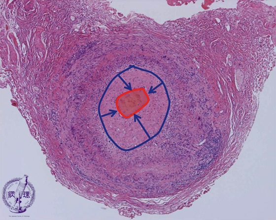 巨細胞性動脈炎ミクロ像(HE弱拡大)