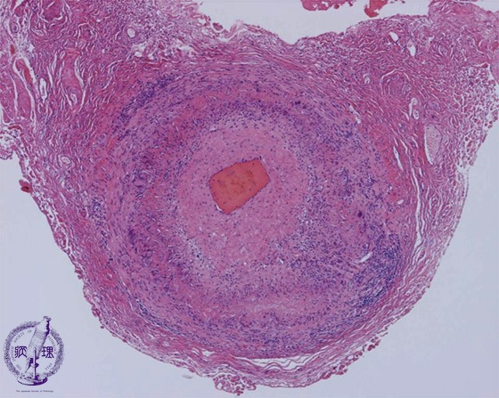 巨細胞性動脈炎ミクロ像(HE弱拡大)