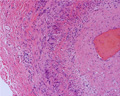 巨細胞性動脈炎ミクロ像(HE中拡大)