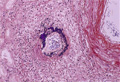結節性動脈周囲炎ミクロ像（PTAH染色強拡大）