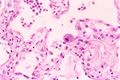 ウイルス性肺炎（巨細胞封入体（ＣＭＶ）肺炎）ミクロ像（HE強拡大）