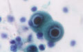 ウイルス性肺炎（巨細胞封入体（ＣＭＶ）肺炎）ミクロ像（パパニコロウ染色強拡大）