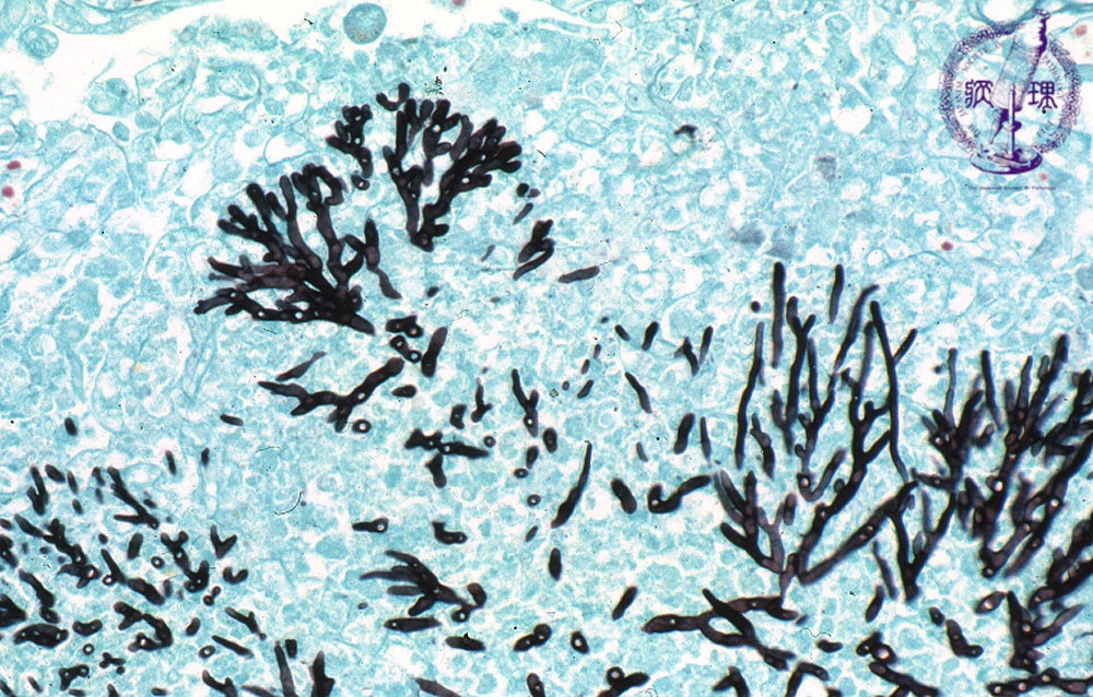 5.肺・胸膜 (9)真菌性肺炎（アスペルギルス）|病理コア画像