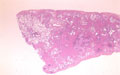 間質性肺炎（通常型間質性肺炎UIP）ミクロ像（HEルーペ像）