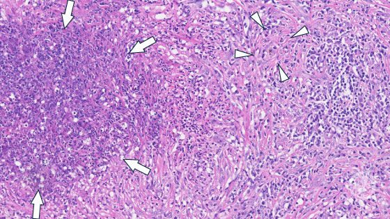 �������ǉ��������ǂ̔x�a��