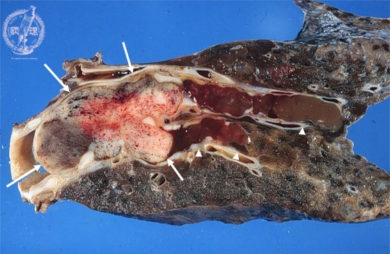 カルチノイド腫瘍マクロ像