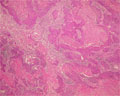 非小細胞肺癌（扁平上皮癌）ミクロ像（HE弱拡大）