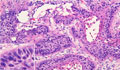 非小細胞肺癌（扁平上皮癌）ミクロ像（HE強拡大）