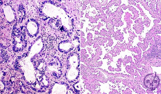 非小細胞肺癌（腺癌）ミクロ像（左：HE強拡大、右：中拡大）