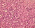 非小細胞肺癌（腺癌）ミクロ像（HE強拡大）